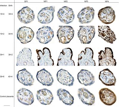 Inefficient Placental Virus Replication and Absence of Neonatal Cell-Specific Immunity Upon Sars-CoV-2 Infection During Pregnancy